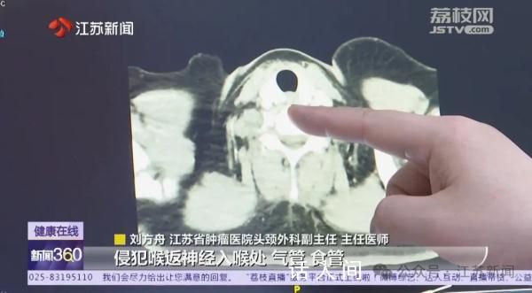 一家三口同患上甲状腺癌 哪些筛查不能忽视